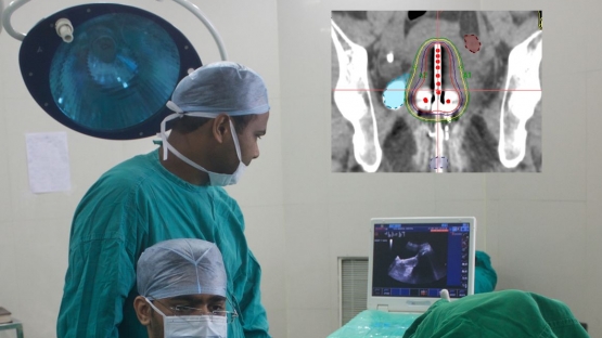 cancer brachytherapy 